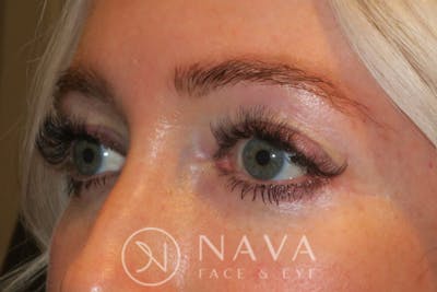 Lower Blepharoplasty (Lower Eyelid Surgery) Before & After Gallery - Patient 143347574 - Image 6