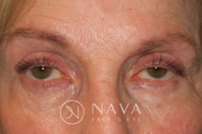Ptosis Repair Before & After Gallery - Patient 148992229 - Image 1
