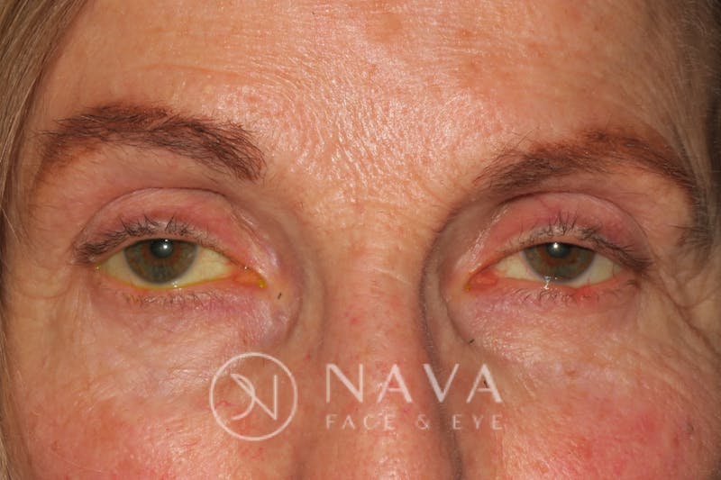 Ptosis Repair Before & After Gallery - Patient 143442200 - Image 1