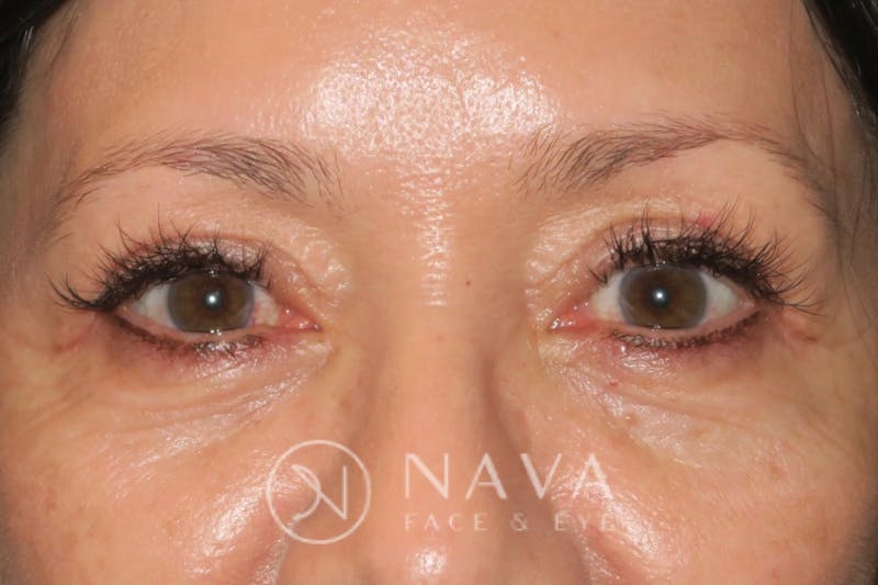 Browplasty Before & After Gallery - Patient 143347595 - Image 2