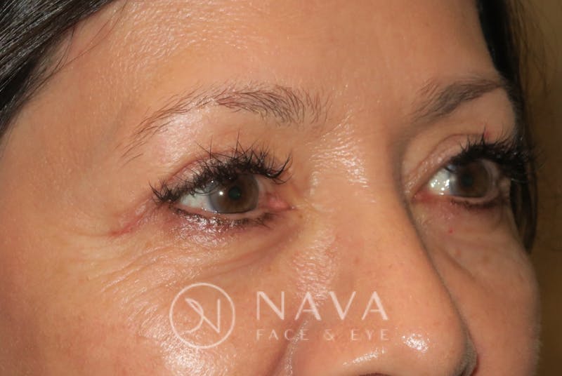 Browplasty (Brow Lift) Before & After Gallery - Patient 143347595 - Image 4