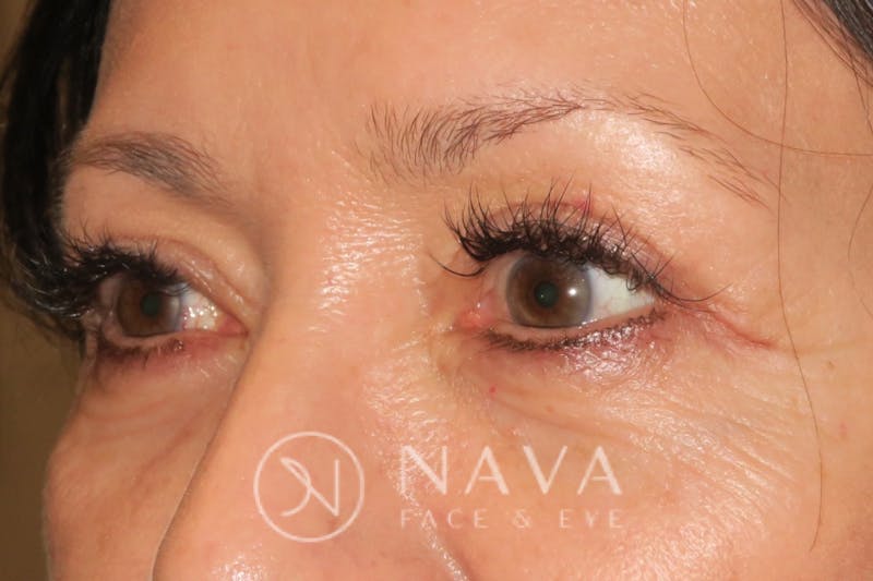 Ptosis Repair Before & After Gallery - Patient 143442197 - Image 6