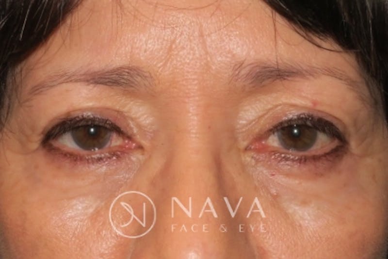 Browplasty (Brow Lift) Before & After Gallery - Patient 143347595 - Image 1