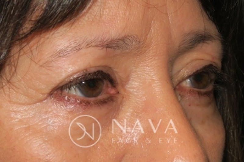 Ptosis Repair Before & After Gallery - Patient 143442197 - Image 3