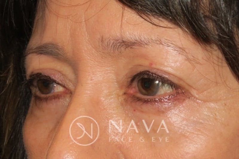 Browplasty (Brow Lift) Before & After Gallery - Patient 143347595 - Image 5