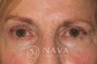 Ptosis Repair Before & After Gallery - Patient 148992229 - Image 2