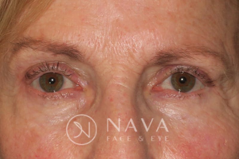 Ptosis Repair Before & After Gallery - Patient 148992229 - Image 2