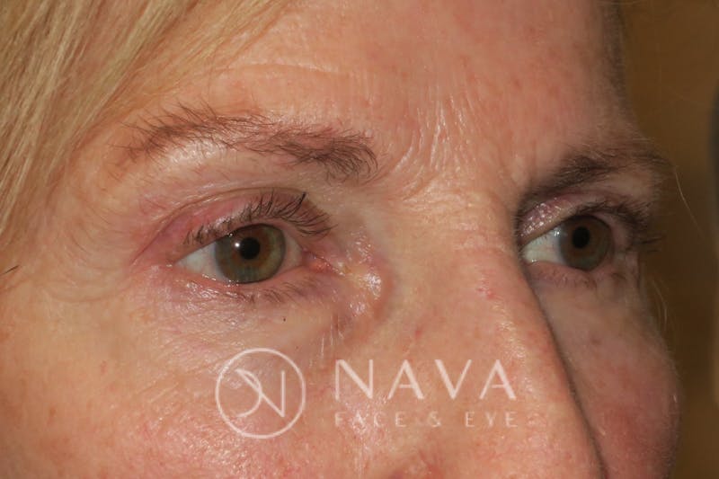 Ptosis Repair Before & After Gallery - Patient 148992229 - Image 4