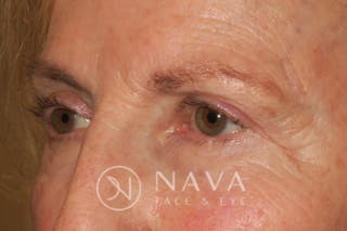 Ptosis Repair Before & After Gallery - Patient 148992229 - Image 6