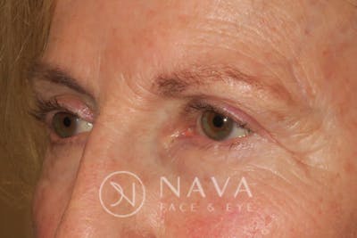 Ptosis Repair Before & After Gallery - Patient 148992229 - Image 6