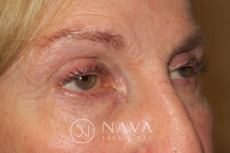 Ptosis Repair Before & After Gallery - Patient 148992229 - Image 3