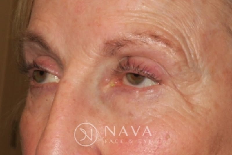Ptosis Repair Before & After Gallery - Patient 148992229 - Image 5