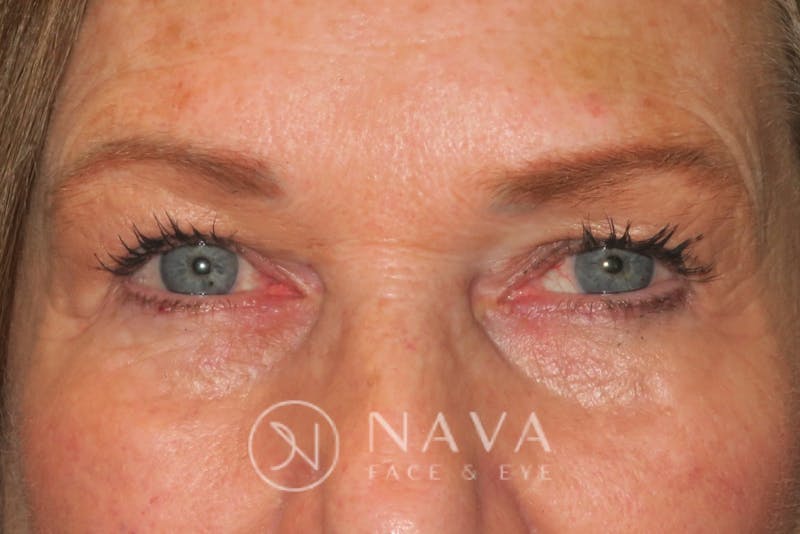 Browplasty (Brow Lift) Before & After Gallery - Patient 143347615 - Image 2