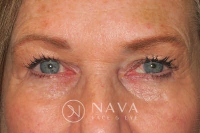 Ptosis Repair Before & After Gallery - Patient 143442199 - Image 2