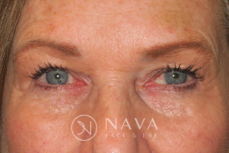 Browplasty (Brow Lift) Before & After Gallery - Patient 143347615 - Image 2