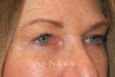 Ptosis Repair Before & After Gallery - Patient 143442199 - Image 4
