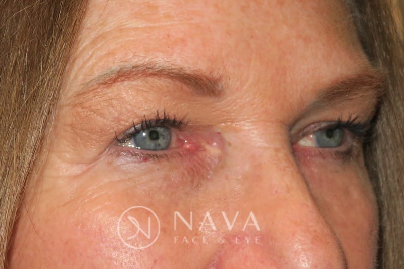 Browplasty (Brow Lift) Before & After Gallery - Patient 143347615 - Image 4