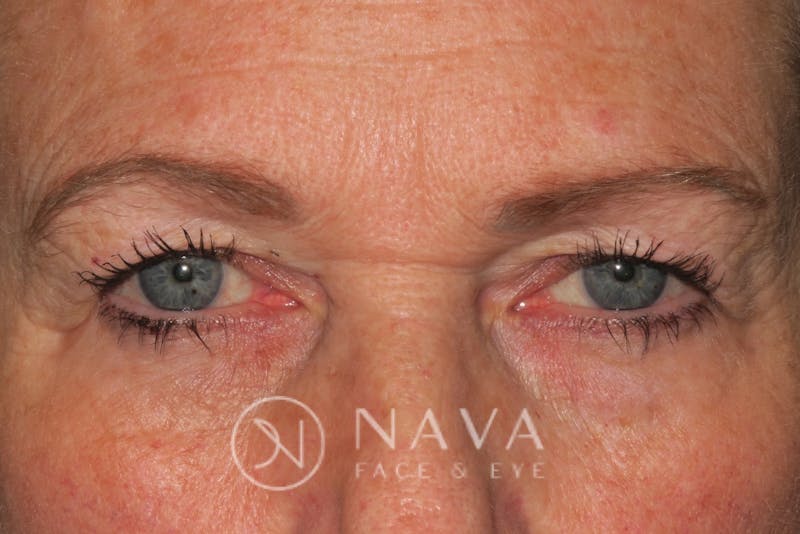 Ptosis Repair Before & After Gallery - Patient 143442199 - Image 1