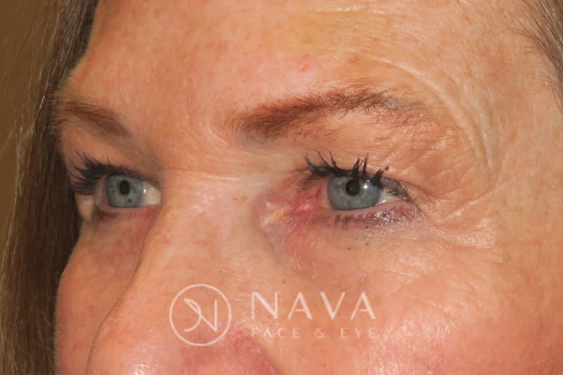 Ptosis Repair Before & After Gallery - Patient 143442199 - Image 6