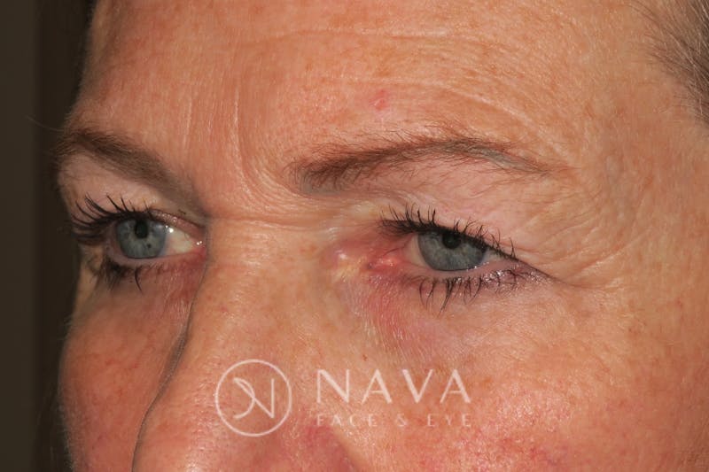 Browplasty Before & After Gallery - Patient 143347615 - Image 5