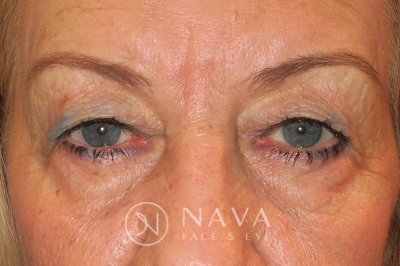 Upper Blepharoplasty (Upper Eyelid Surgery) Before & After Gallery - Patient 143347651 - Image 1