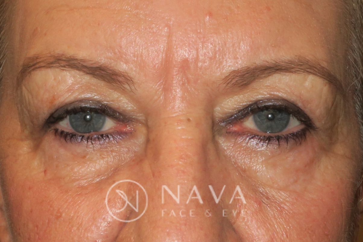 Upper Blepharoplasty (Upper Eyelid Surgery) Before & After Photos ...