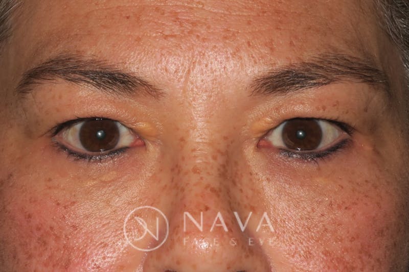 Upper Blepharoplasty (Upper Eyelid Surgery) Before & After Gallery - Patient 143347652 - Image 1