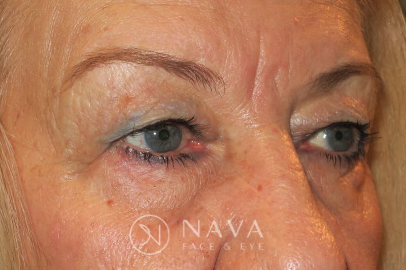 Upper Blepharoplasty Before & After Gallery - Patient 143347651 - Image 3