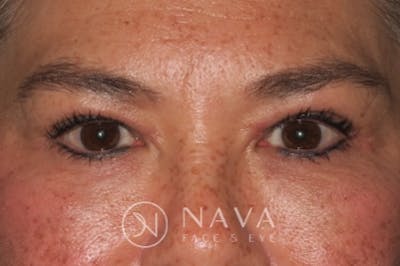Upper Blepharoplasty (Upper Eyelid Surgery) Before & After Gallery - Patient 143347652 - Image 2