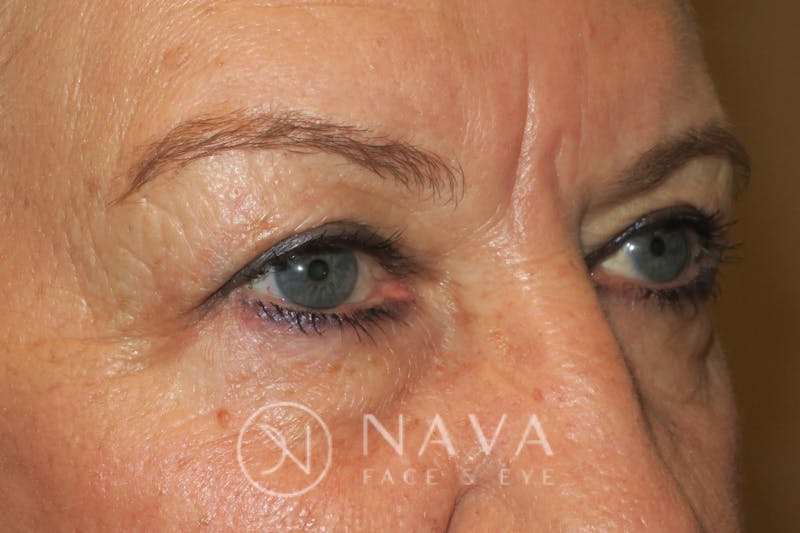 Upper Blepharoplasty Before & After Gallery - Patient 143347651 - Image 4