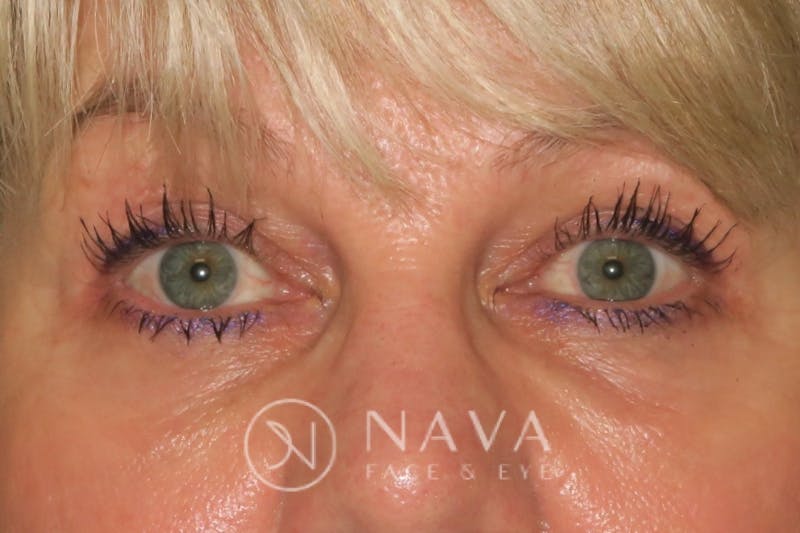 Upper Blepharoplasty (Upper Eyelid Surgery) Before & After Gallery - Patient 143347653 - Image 2