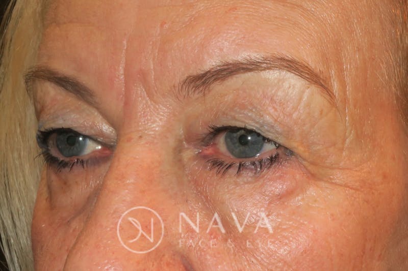 Upper Blepharoplasty (Upper Eyelid Surgery) Before & After Gallery - Patient 143347651 - Image 5