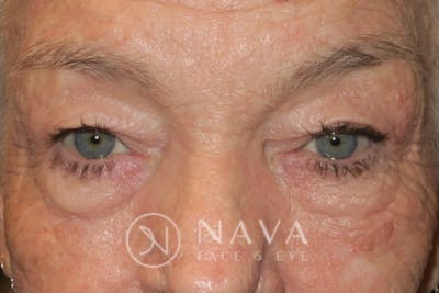 Ptosis Repair Before & After Gallery - Patient 147616640 - Image 1
