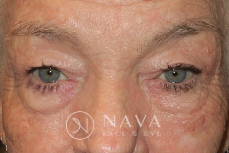 Ptosis Repair Before & After Gallery - Patient 147616640 - Image 1