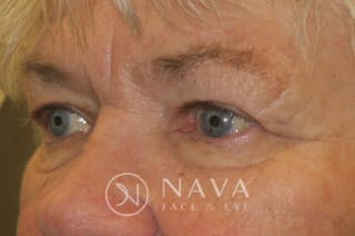 Ptosis Repair Before & After Gallery - Patient 147616639 - Image 6