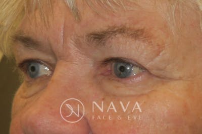 Ptosis Repair Before & After Gallery - Patient 147616639 - Image 6