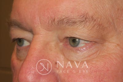 Ptosis Repair Before & After Gallery - Patient 147616570 - Image 5