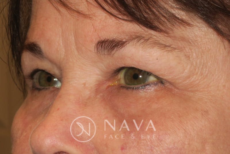 Ptosis Repair Before & After Gallery - Patient 147616576 - Image 6