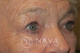 Ptosis Repair Before & After Gallery - Patient 147616640 - Image 4