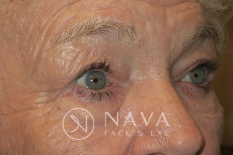 Ptosis Repair Before & After Gallery - Patient 147616640 - Image 4