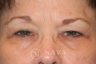 Ptosis Repair Before & After Gallery - Patient 147616576 - Image 1