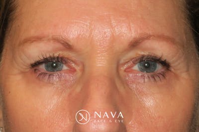 Ptosis Repair Before & After Gallery - Patient 147616641 - Image 1