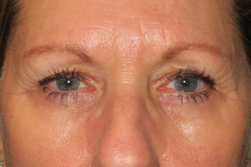 Ptosis Repair Before & After Gallery - Patient 147616641 - Image 1