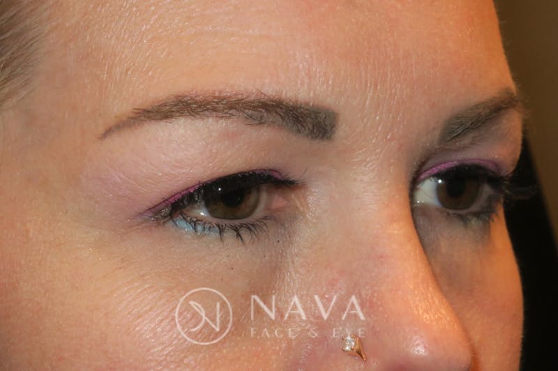 Ptosis Repair Before & After Gallery - Patient 147616557 - Image 3