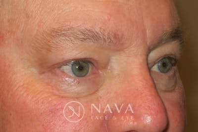 Ptosis Repair Before & After Gallery - Patient 147616570 - Image 4