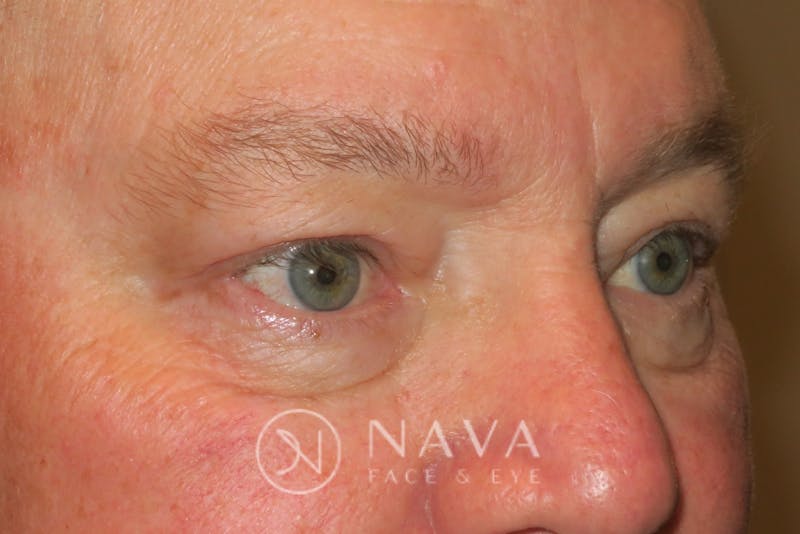Ptosis Repair Before & After Gallery - Patient 147616570 - Image 4