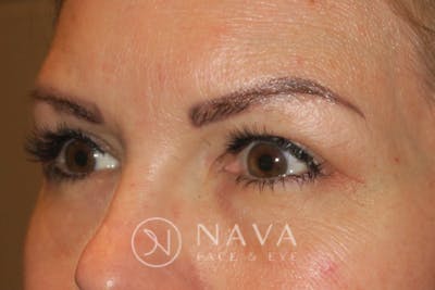 Ptosis Repair Before & After Gallery - Patient 147616557 - Image 6