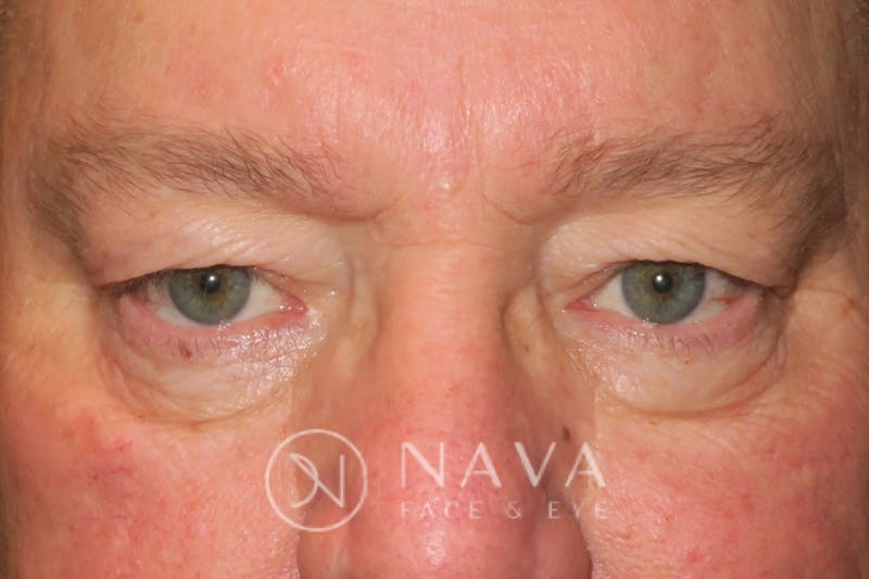 Ptosis Repair Before & After Gallery - Patient 147616570 - Image 1