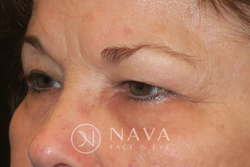 Ptosis Repair Before & After Gallery - Patient 147616576 - Image 5