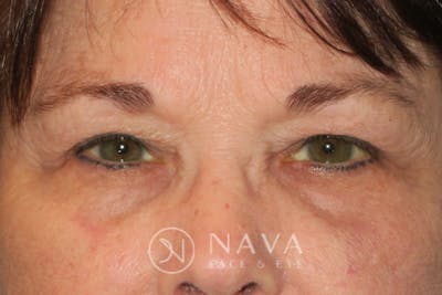Ptosis Repair Before & After Gallery - Patient 147616576 - Image 2